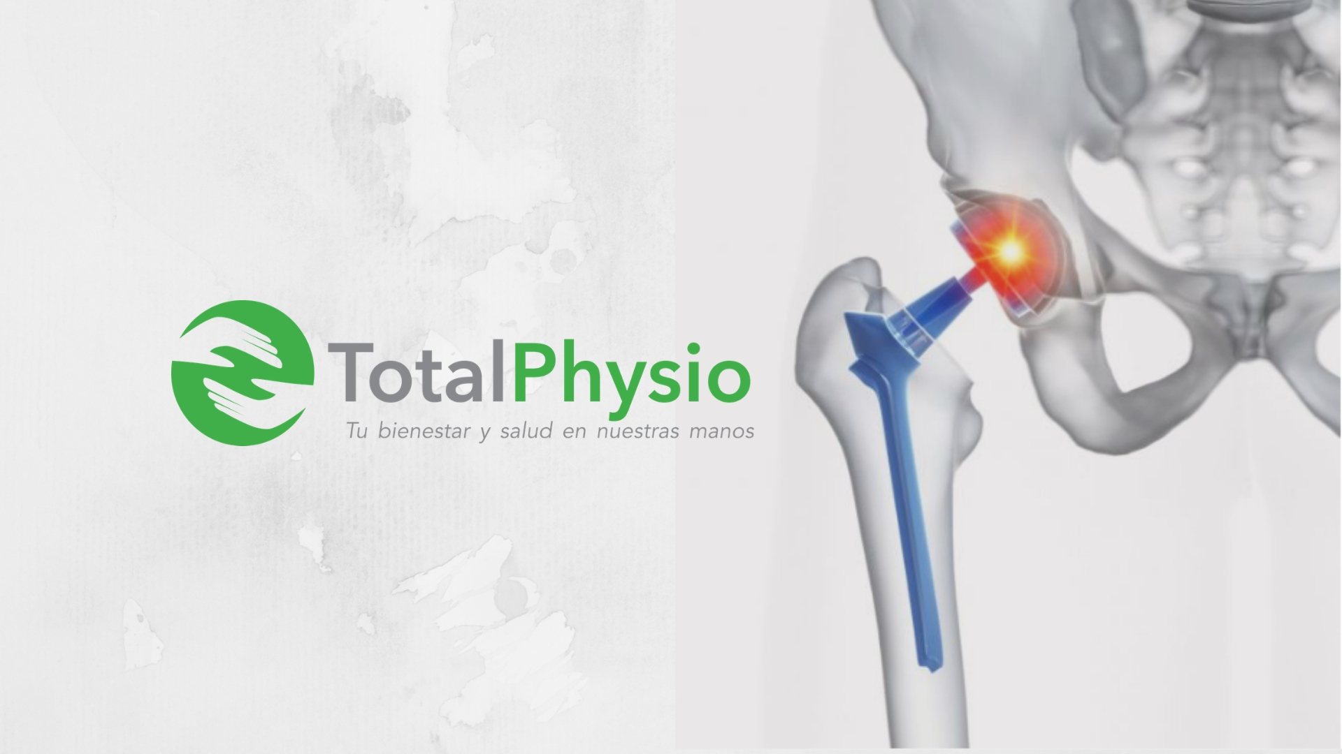 Fisioterapia en prótesis de cadera posterior TotalPhysio Fisioterapia en prótesis de cadera posterior TotalPhysio